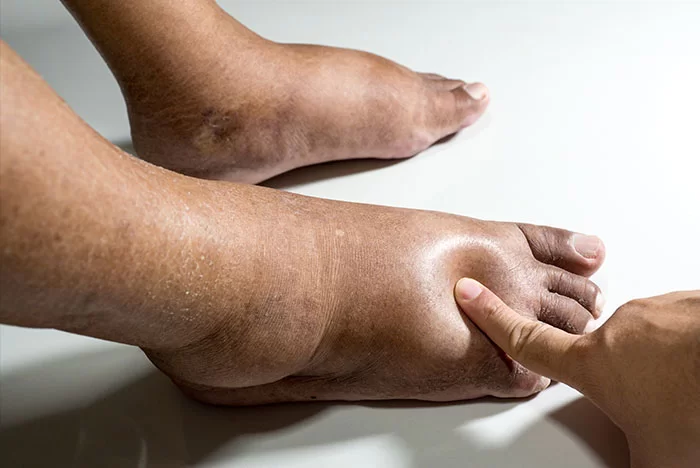 pie diabetico neuropatico