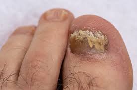 uñas en los pies3