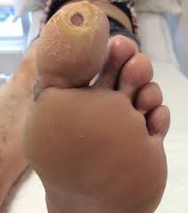 diabetes
