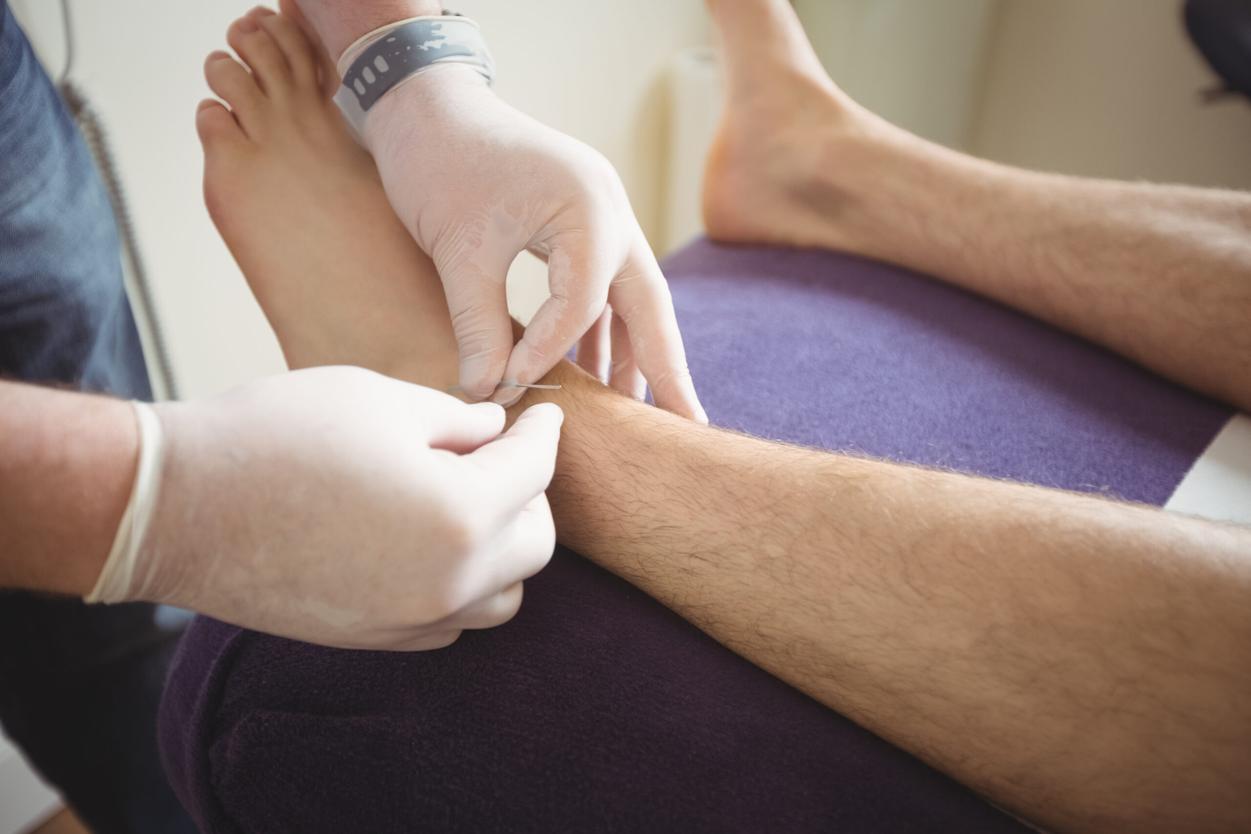 close up of physiotherapist performing dry needling on the leg of a patient in clinic