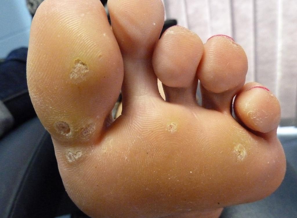 verruga plantar